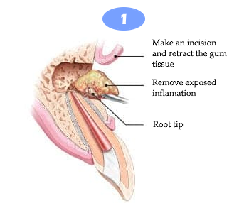 Apicoectomy 1