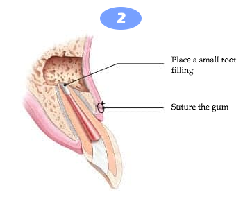Apicoectomy 2