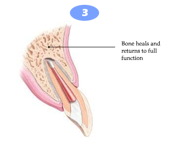 Apicoectomy 3